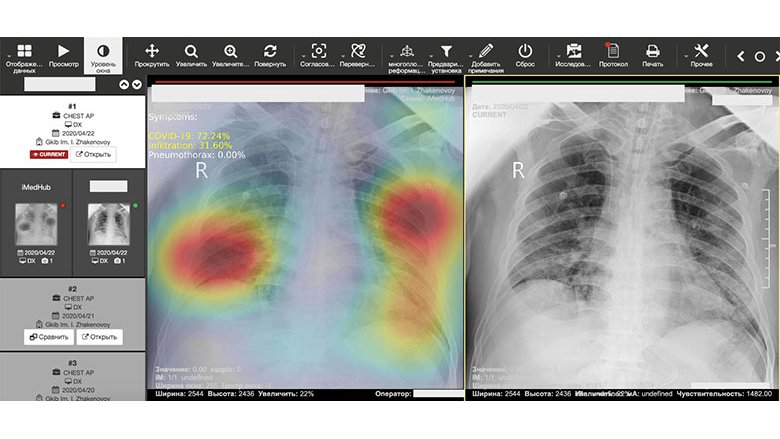 PneumoNet AI software interface